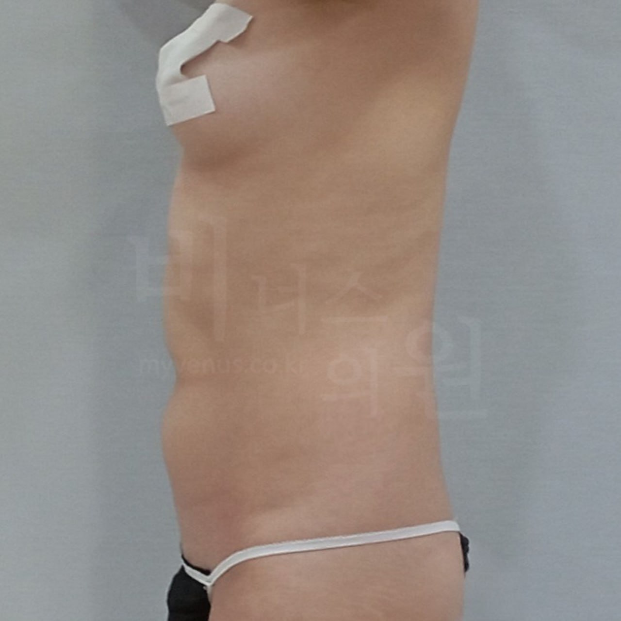 복부 지방흡입 수술 전 측면 — 비너스의원 부천 상동역