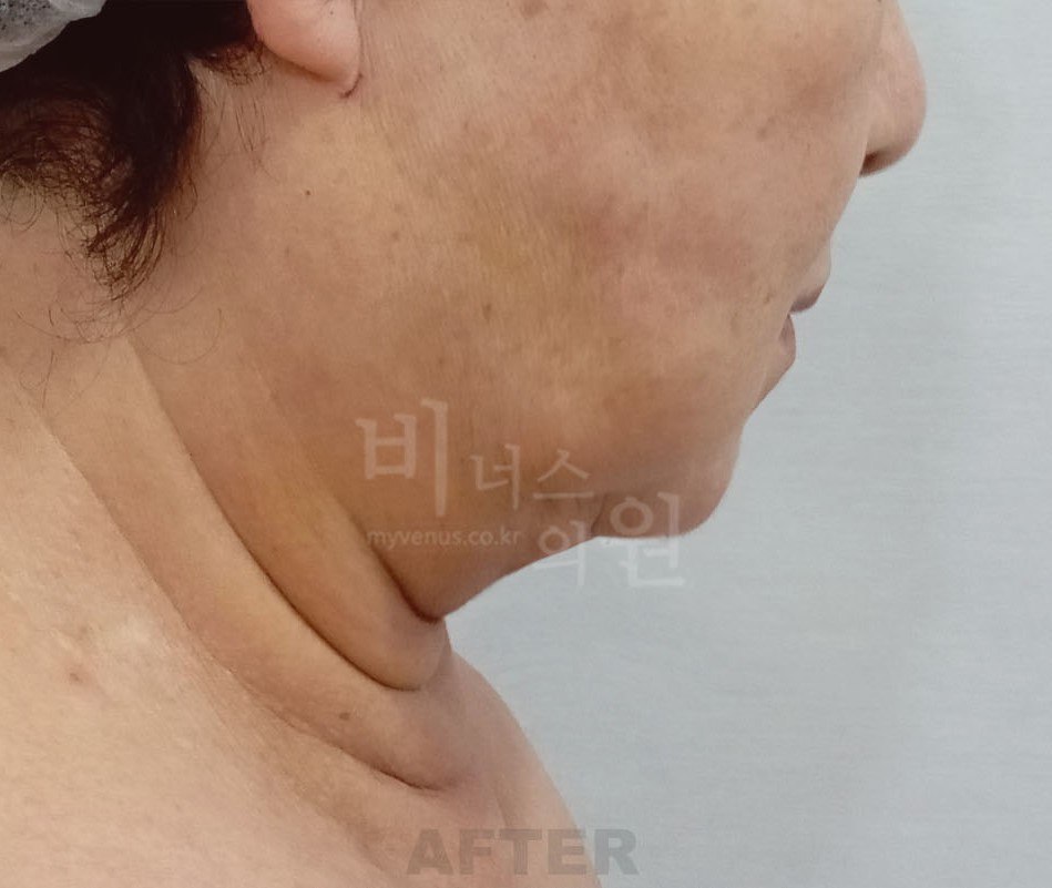 턱지방흡입 수술 후 왼측면 비너스의원