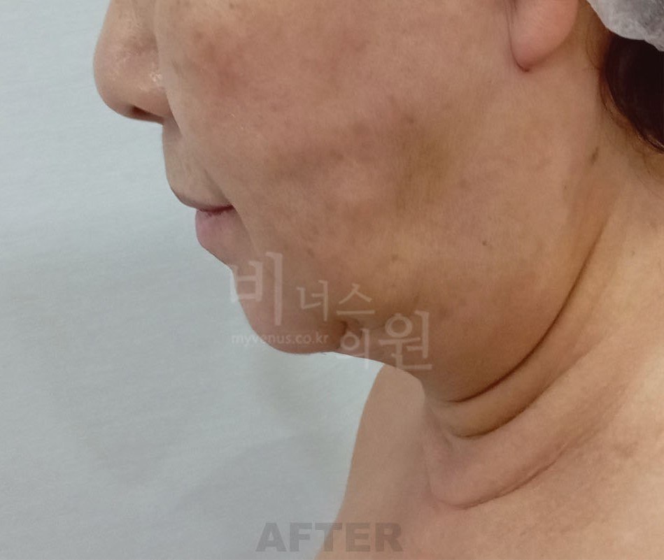 턱지방흡입 수술 후 우측면 비너스의원