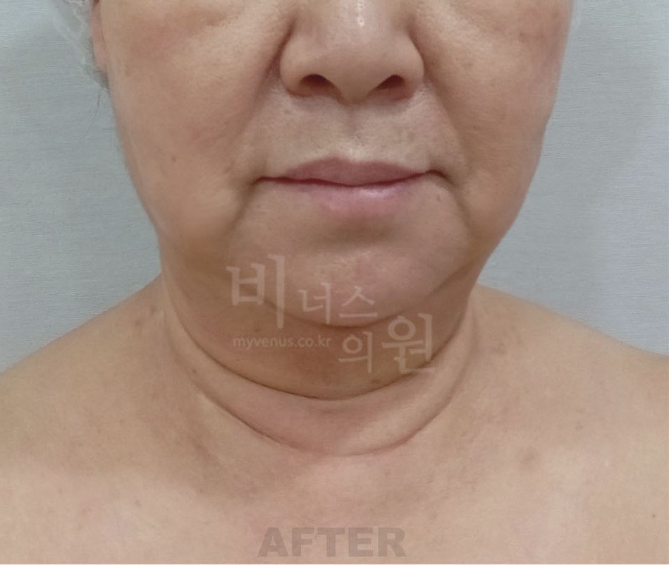 턱지방흡입 수술 후 정면 비너스의원