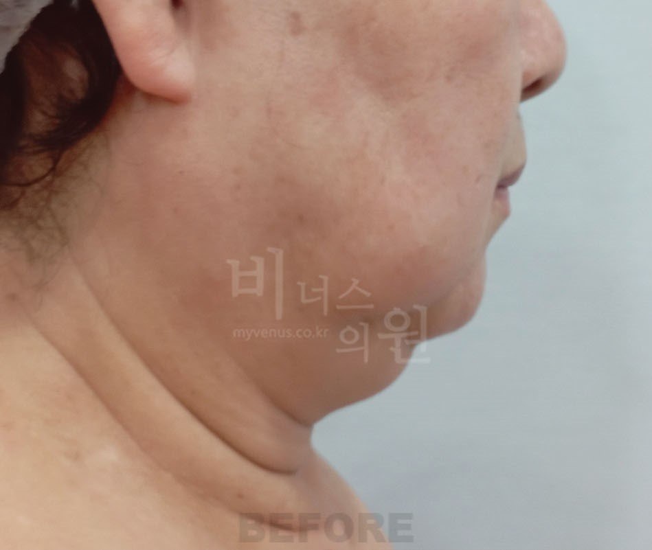턱지방흡입 수술 전 왼측면 비너스의원
