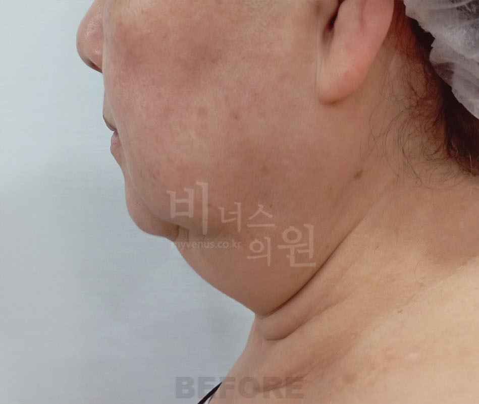턱지방흡입 수술 전 우측면 비너스의원