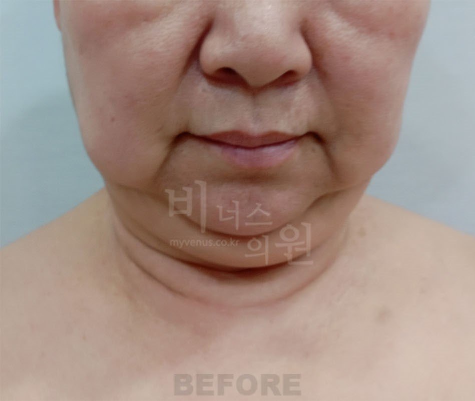 턱지방흡입 수술 전 정면 비너스의원
