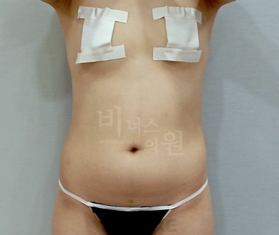 복부지방흡입 수술 전 정면 비너스의원