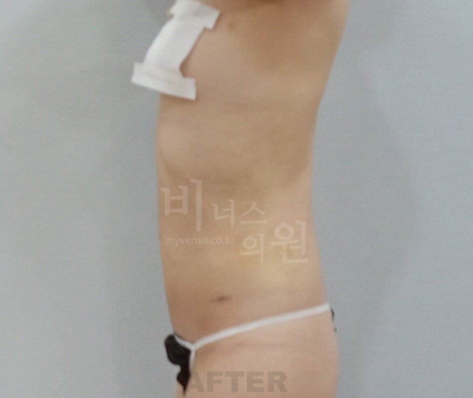 복부지방흡입 수술 후 측면 비너스의원