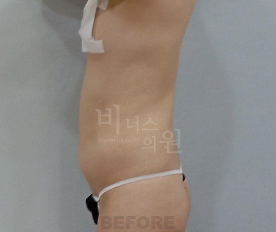 복부지방흡입 수술 전 측면 비너스의원