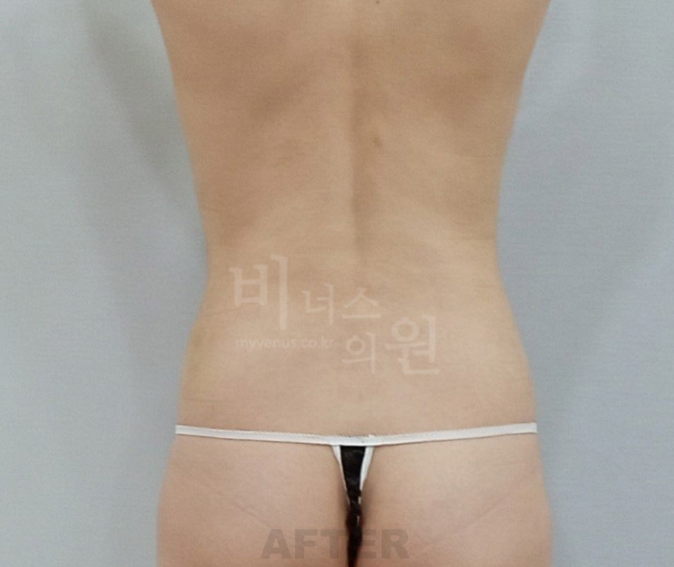 복부지방흡입 수술 후 후면 비너스의원