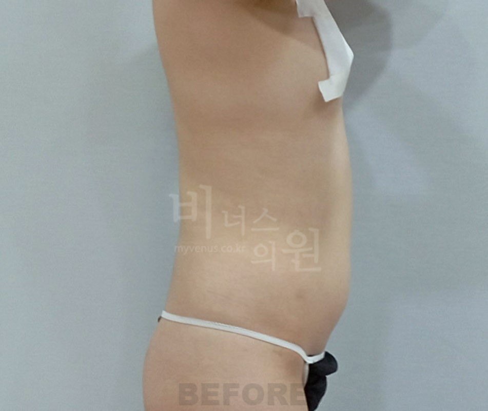 복부지방흡입 수술 전 측면 비너스의원 2