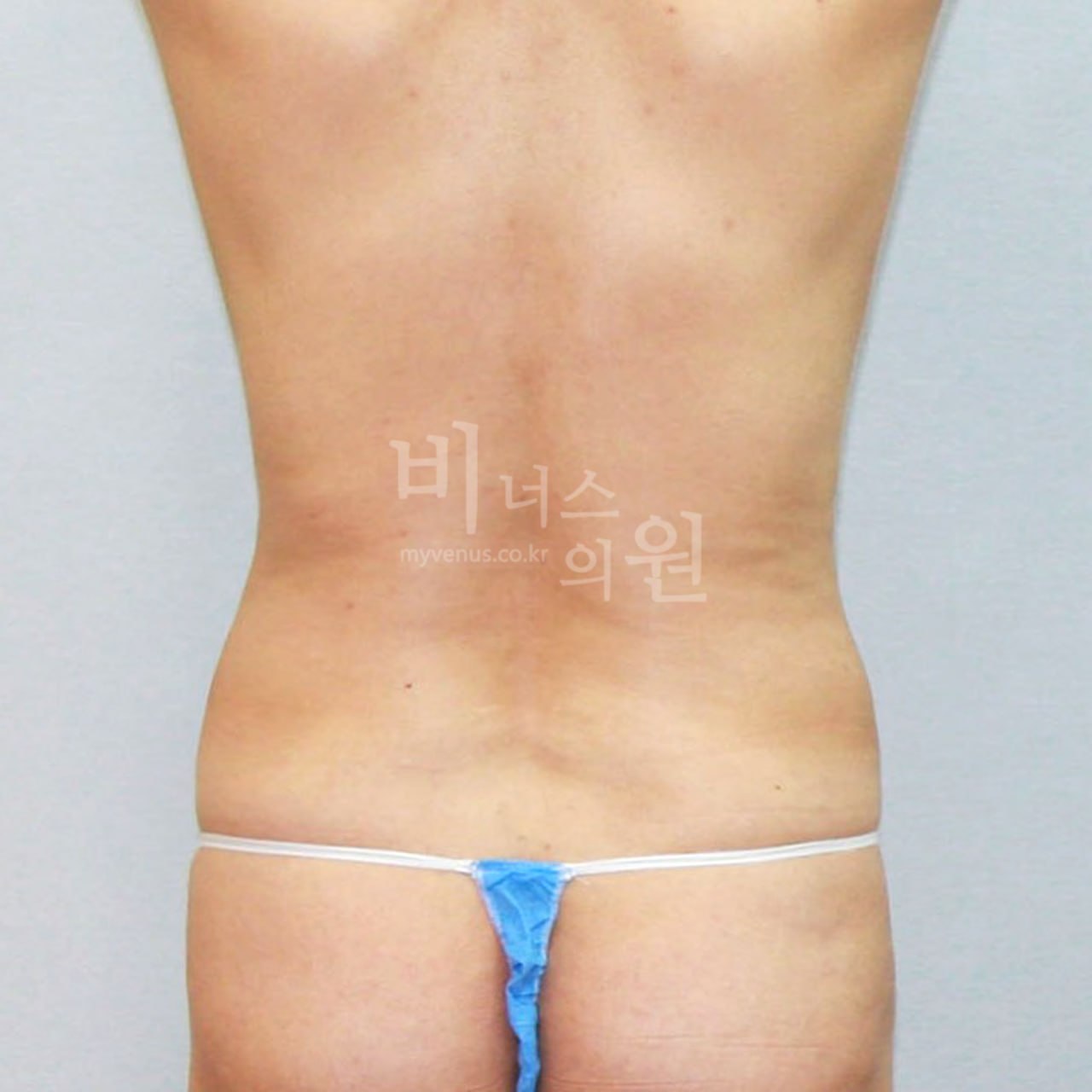 복부지방흡입 전 — 후면