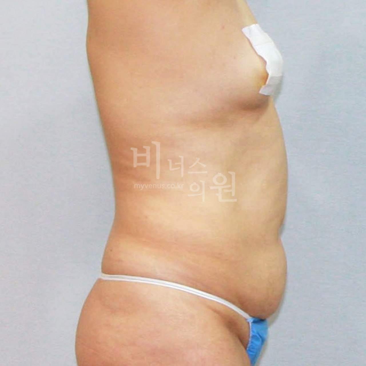 복부지방흡입 전 — 측면
