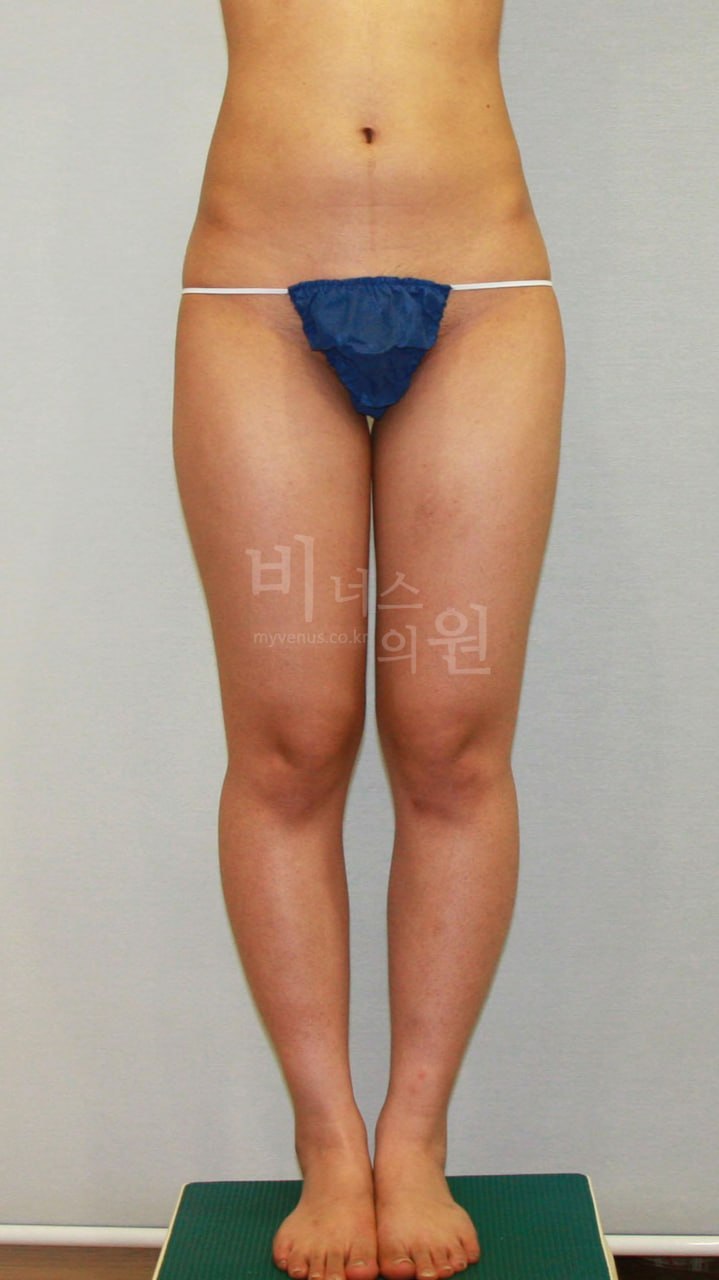 허벅지 지방흡입 정면 수술 전
