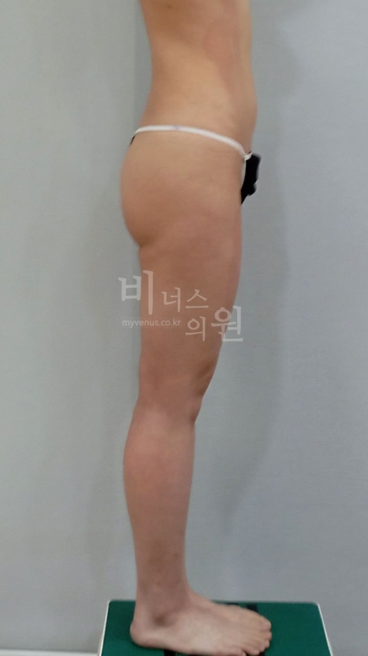 엉덩이 지방흡입 케이스3 수술 전 – 부천 비너스의원