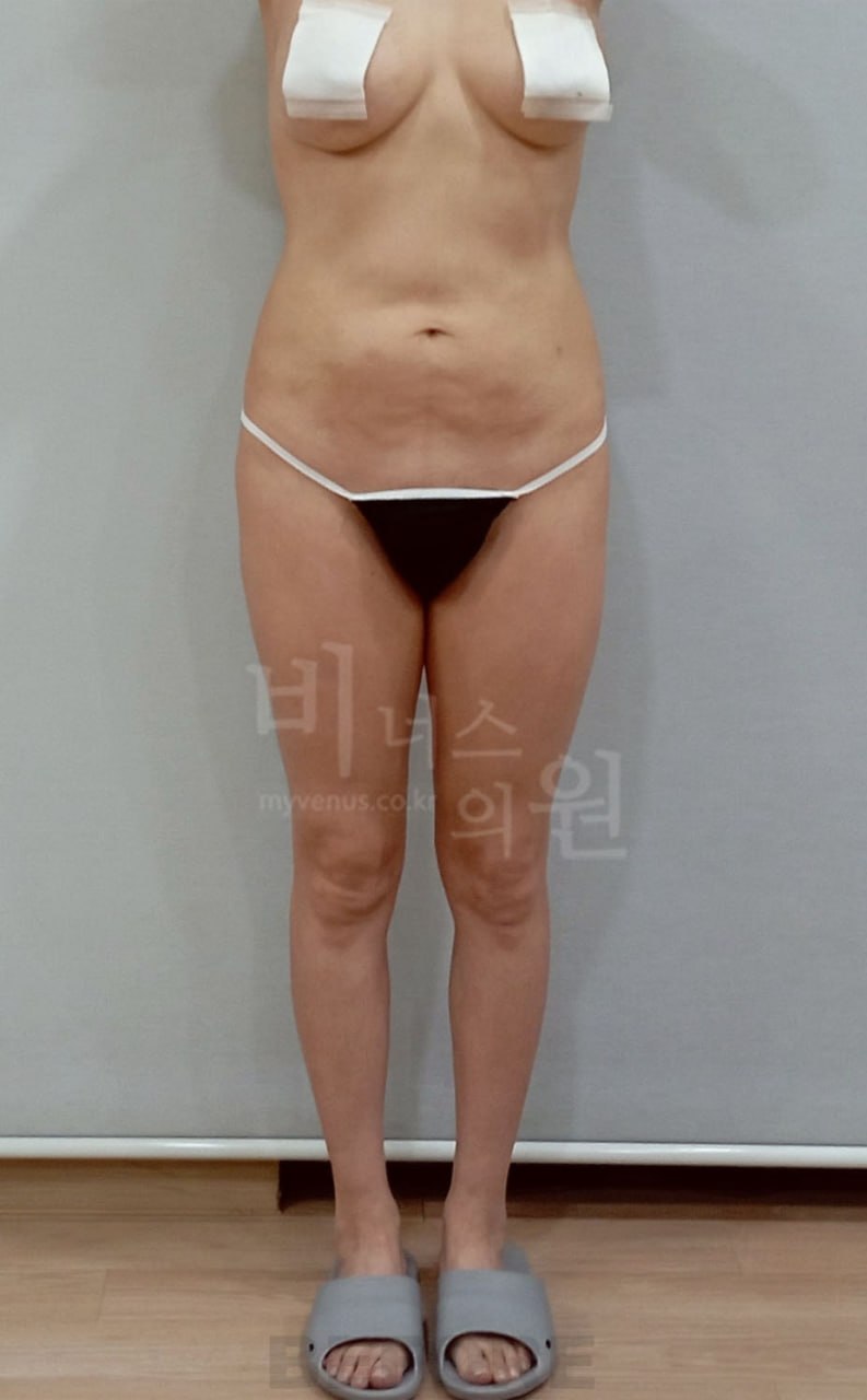 엉덩이 지방흡입 정면 수술 전