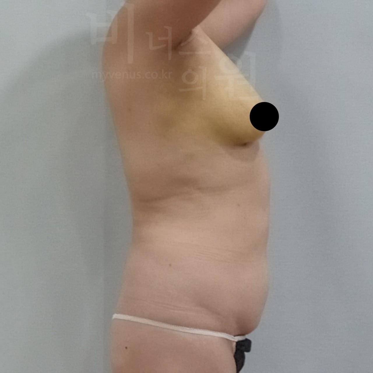 가슴축소 지방흡입 수술 후 비너스의원