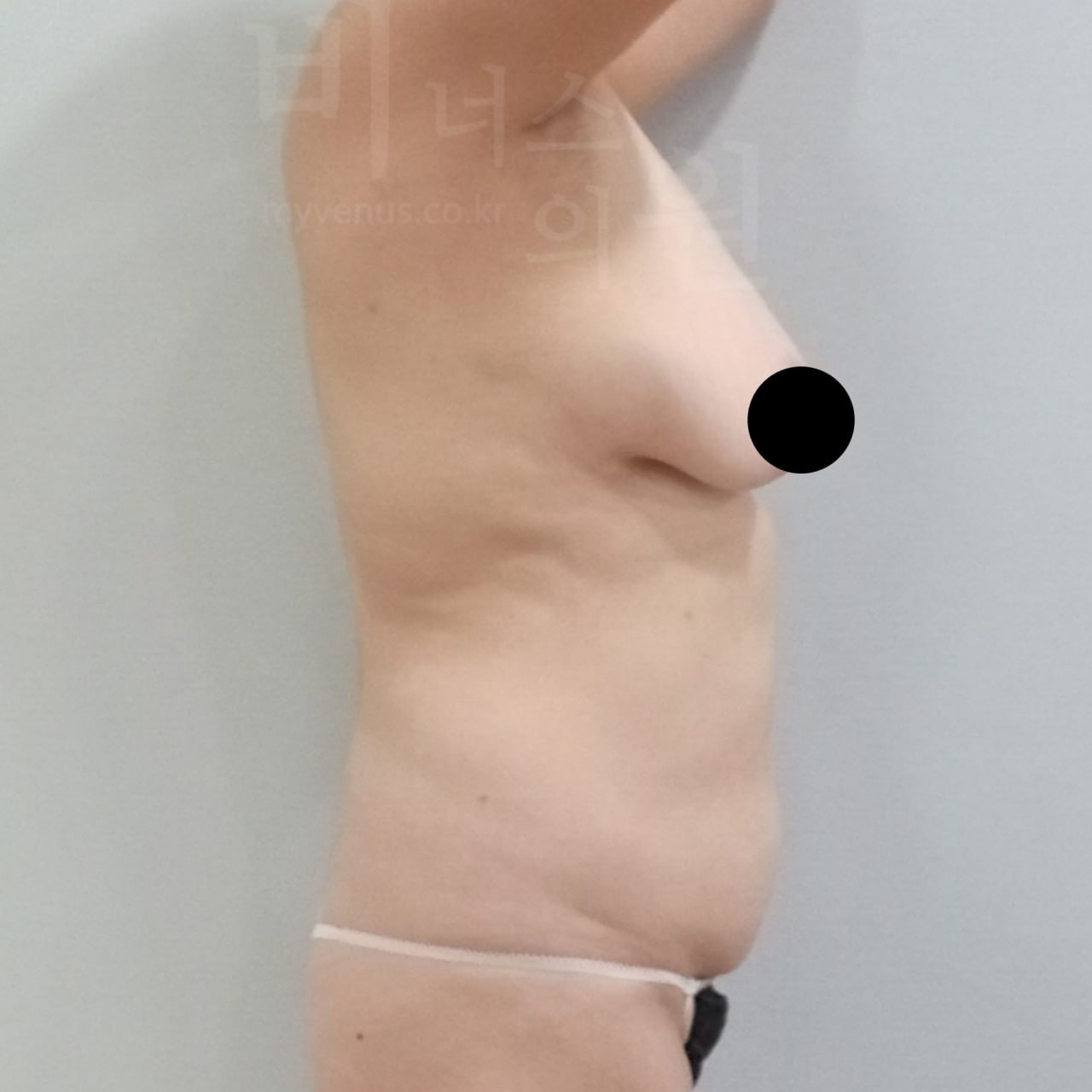 가슴축소 지방흡입 수술 전 비너스의원