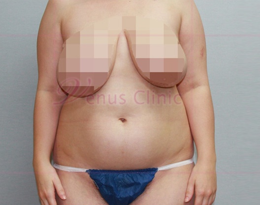 흉복부 지방흡입 수술 전 정면