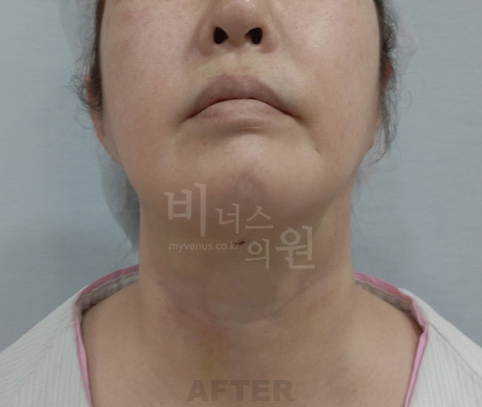 턱지방흡입 수술 후 정면 비너스의원