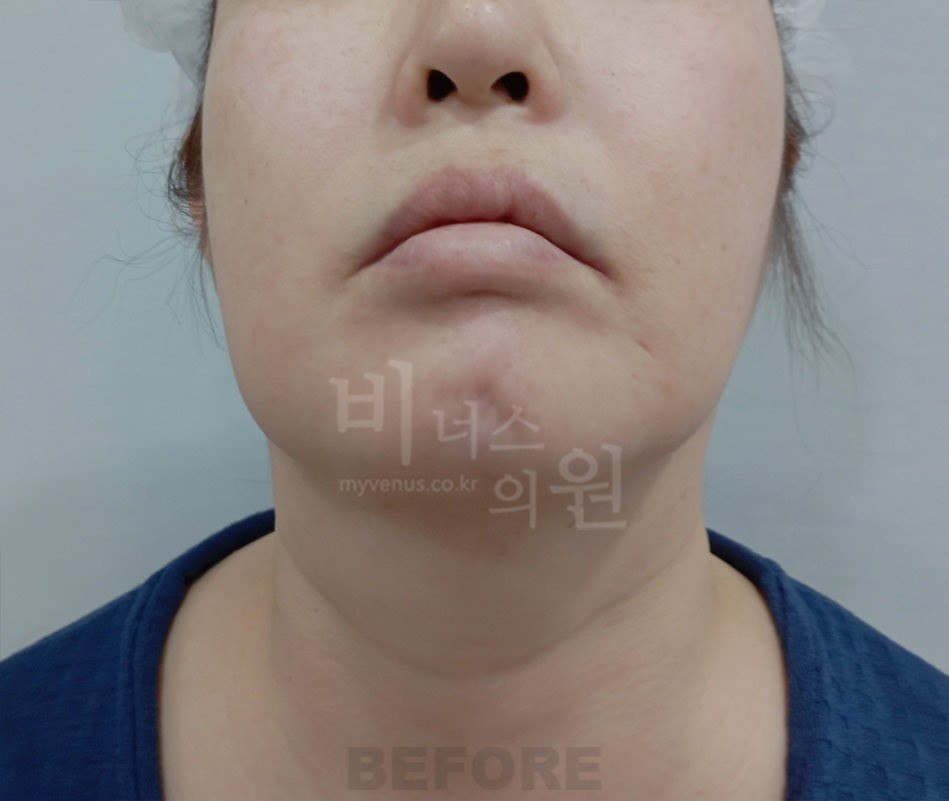 턱지방흡입 수술 전 정면 비너스의원