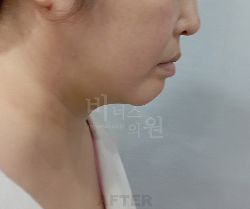 턱지방흡입 수술 후 왼측면 비너스의원