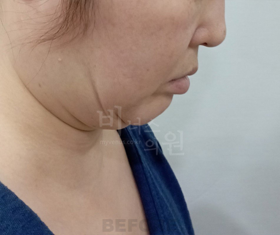 턱지방흡입 수술 전 왼측면 비너스의원