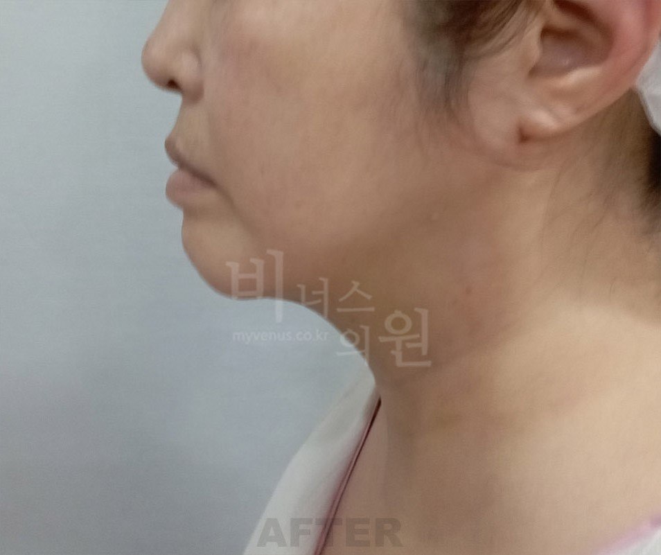 턱지방흡입 수술 후 우측면 비너스의원