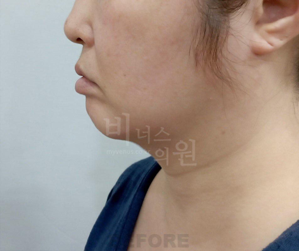 턱지방흡입 수술 전 우측면 비너스의원