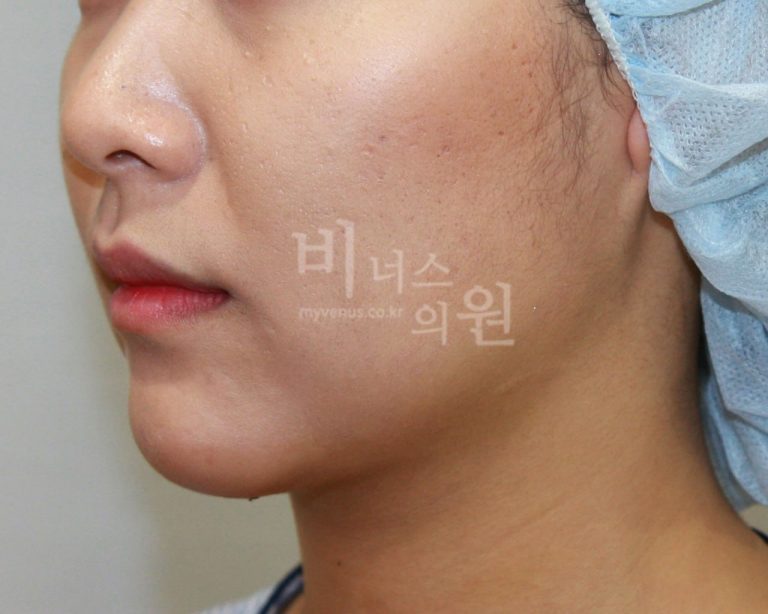 이중턱 지방흡입 후 달라진 일상 — 수술 결심부터 한 달 회복까지, 솔직하게 들여다보기