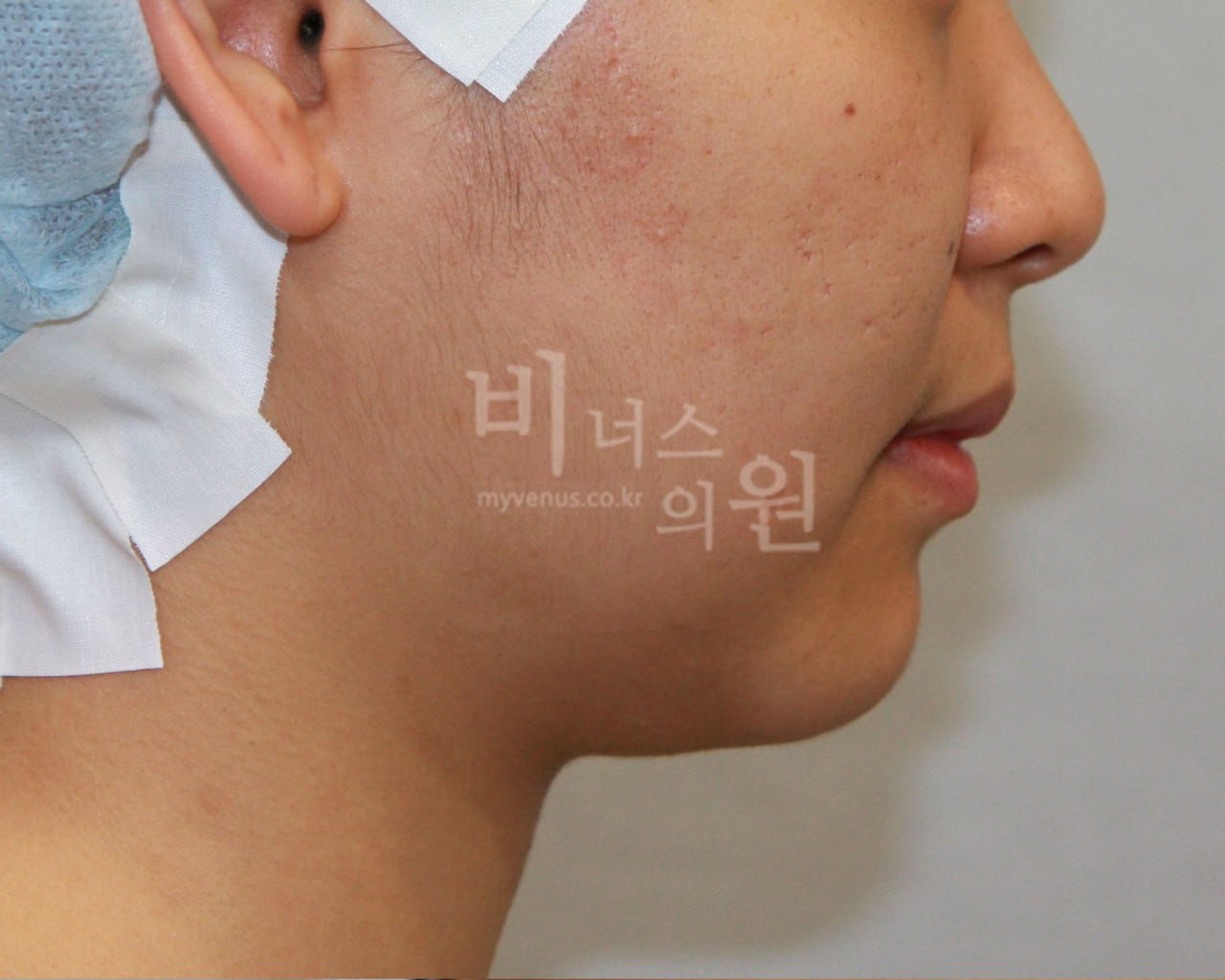 얼굴 이중턱 지방흡입 수술 전 왼측면 비너스의원