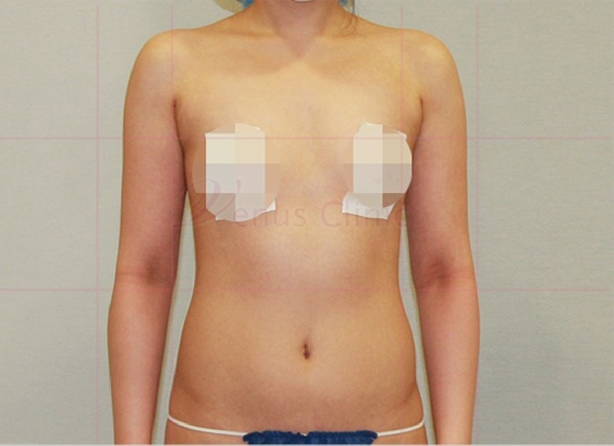 팔뚝 지방흡입 맥시머 수술 후 정면