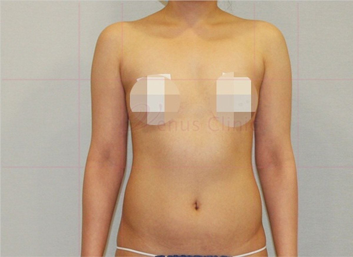 팔뚝 지방흡입 맥시머 수술 전 정면
