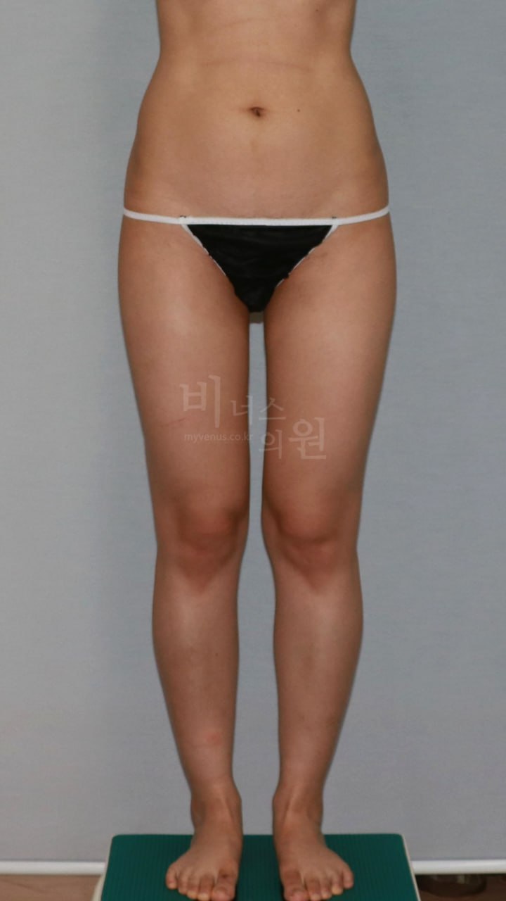 엉덩이 볼륨업 지방흡입 수술 전 정면 비너스의원