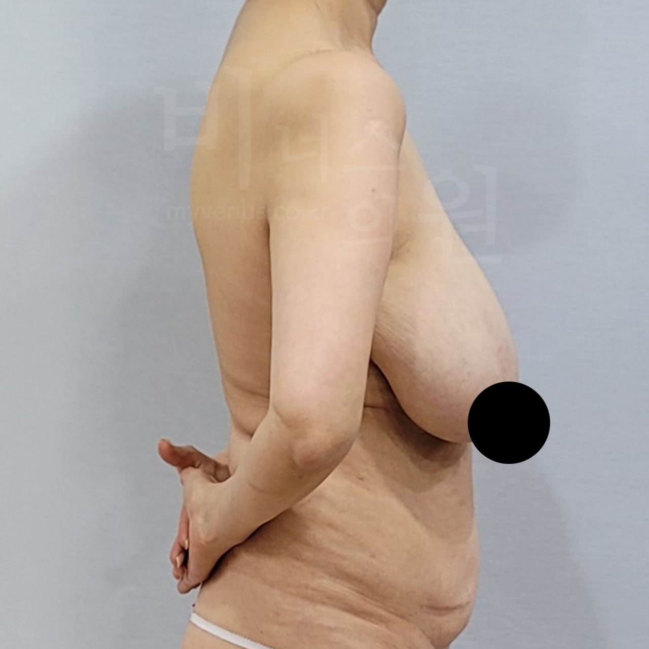 비너스의원 가슴축소 지방흡입 왼측 수술 전