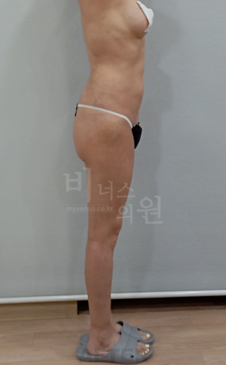 엉덩이 지방흡입 수술 후 측면2 비너스의원