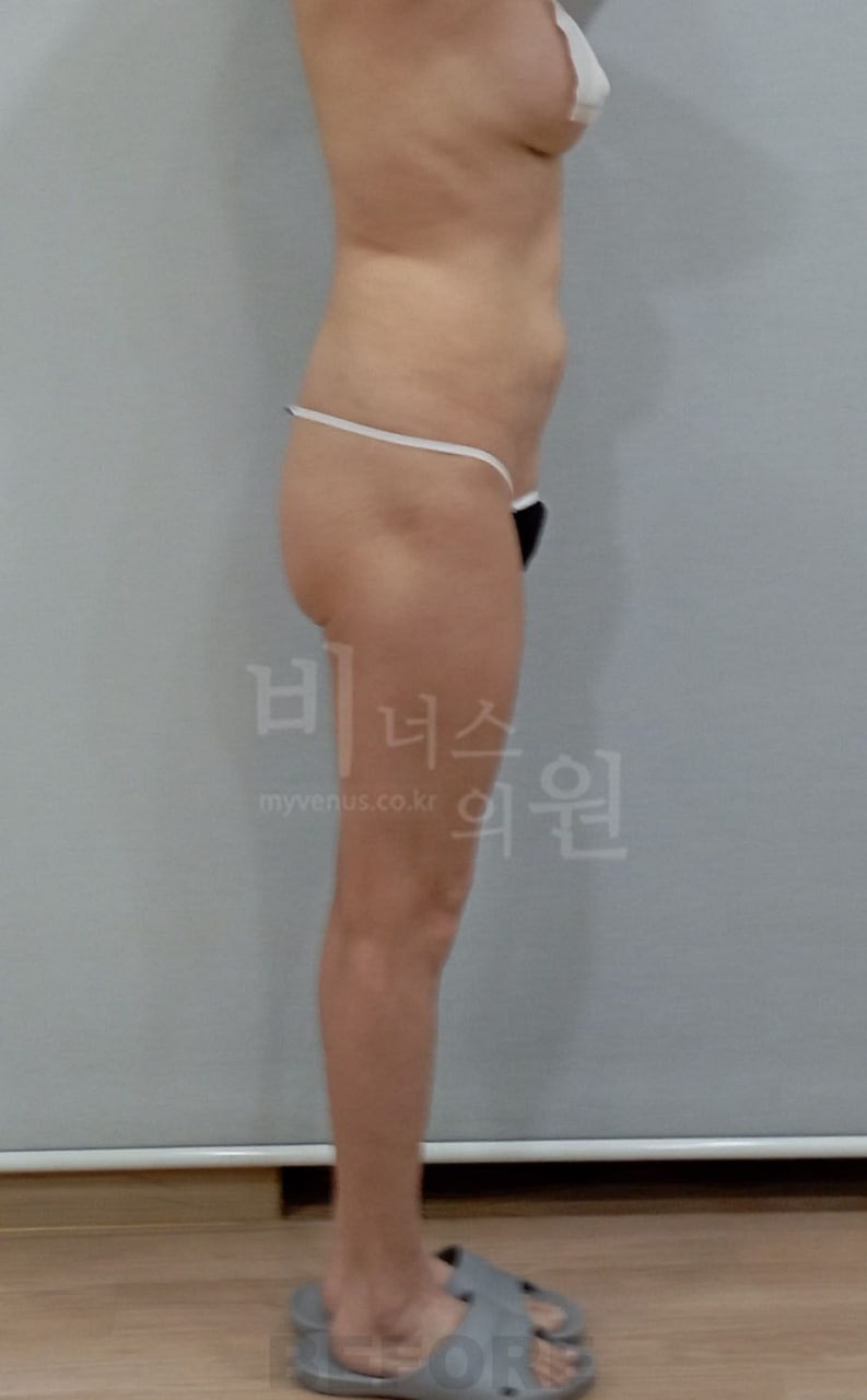 엉덩이 지방흡입 수술 전 측면2 비너스의원