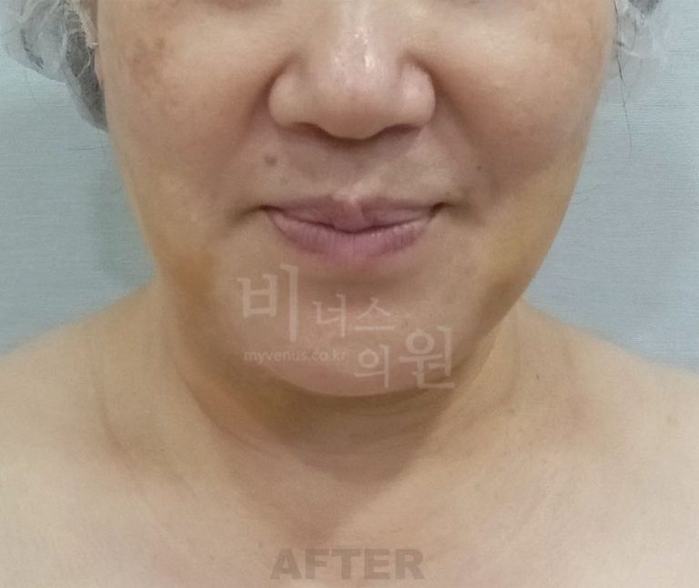 이중턱 턱지방흡입, 수술 당일부터 한 달 회복 솔직 경험기