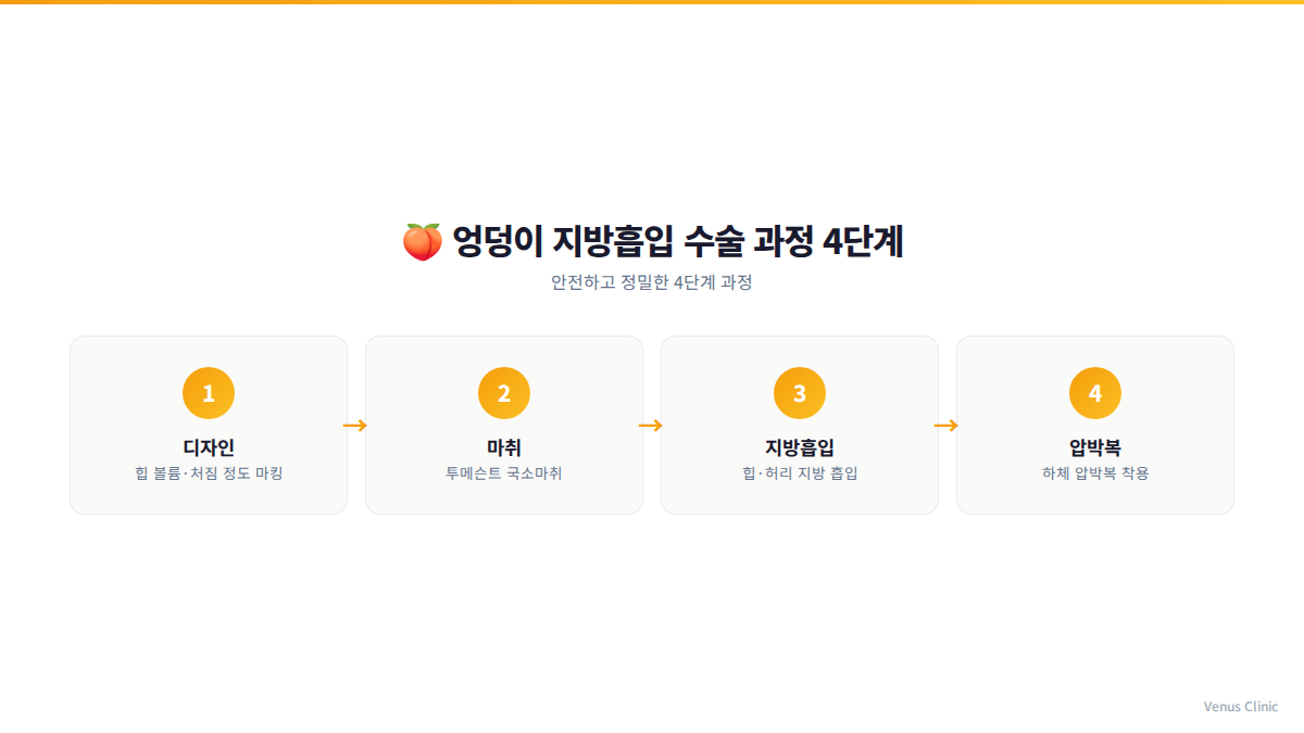 엉덩이 지방흡입 수술 과정 4단계 설명 인포그래픽 – 부천 비너스의원