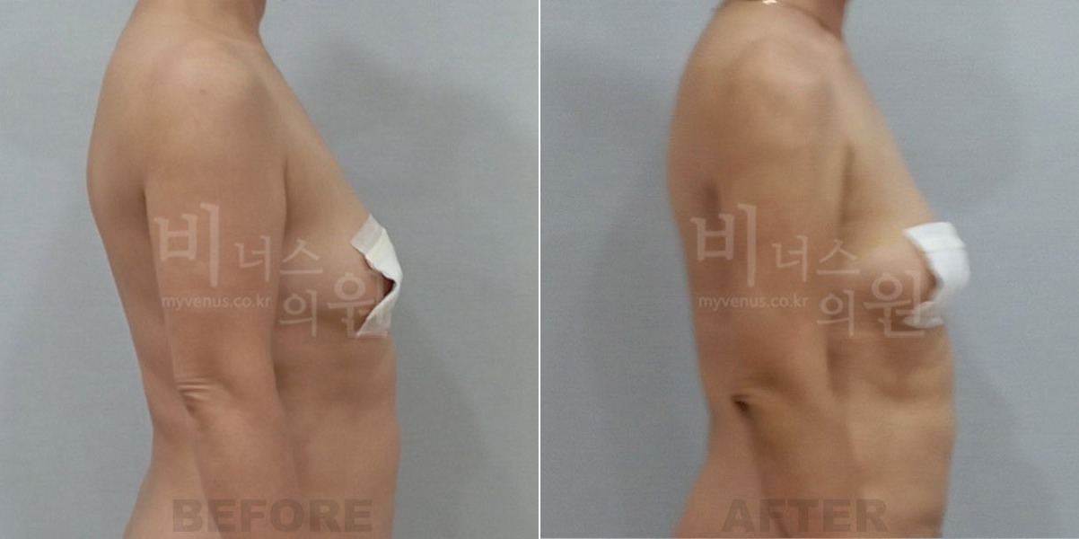 팔뚝 지방흡입 수술 전후 측면 비교 — 비너스의원