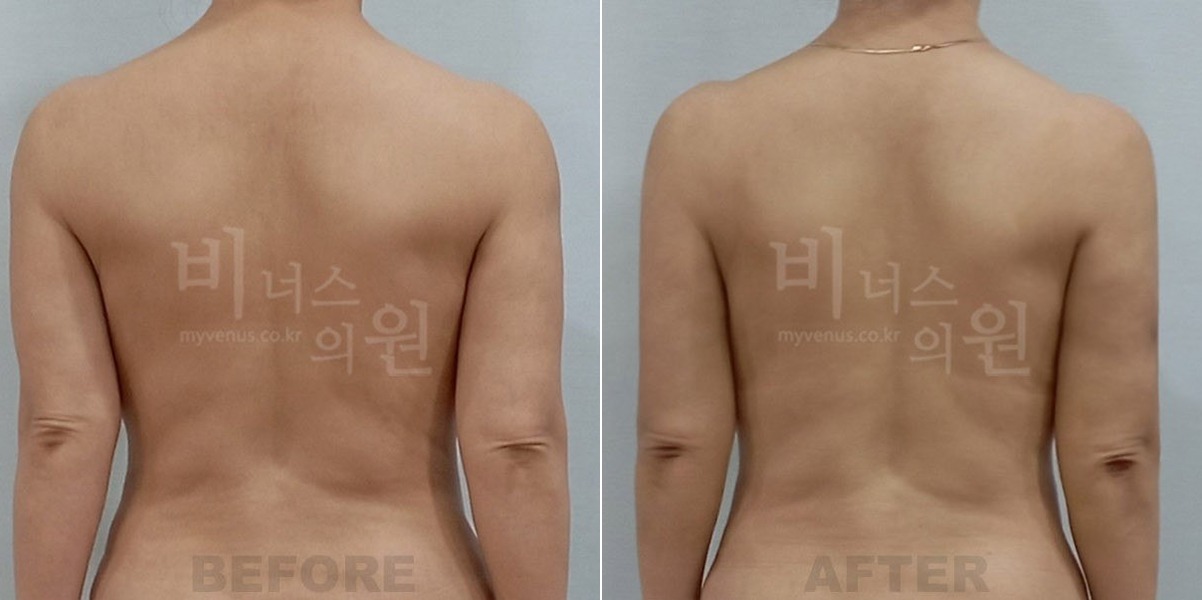 팔뚝 지방흡입 수술 전후 후면 비교 — 비너스의원