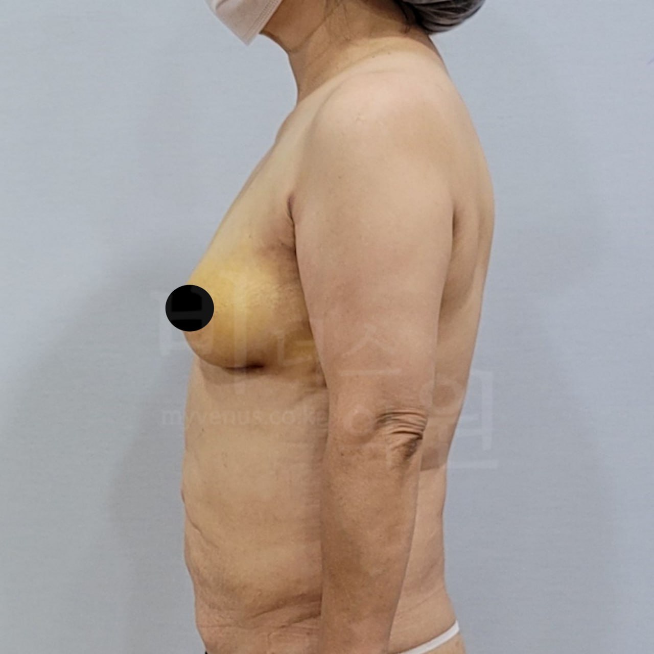 수술 후 — 왼측