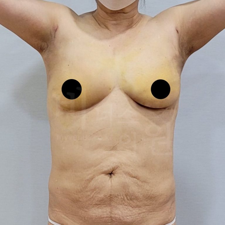 가슴 지방흡입 후 뭉치고 딱딱해지는 느낌 — 경화과정이 좋은 신호인 이유