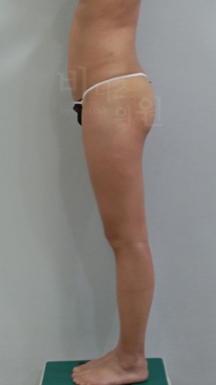 수술 후 — 우측면