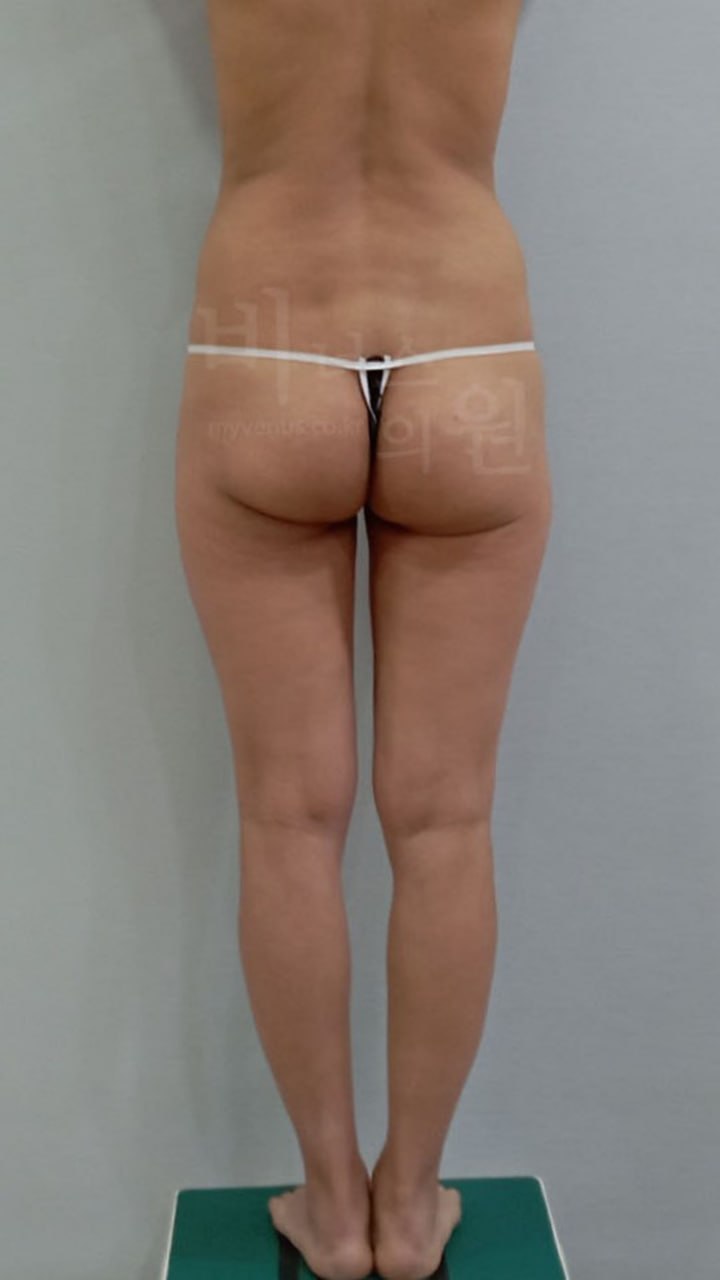 수술 전 — 후면
