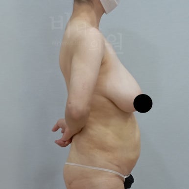 가슴축소 지방흡입 수술 전 왼측 비너스의원