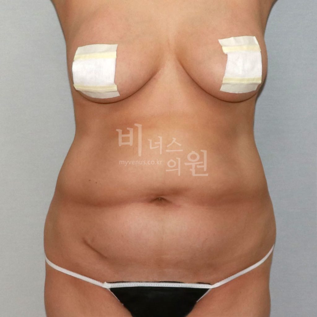 원통형 복부 지방흡입 수술 전 정면