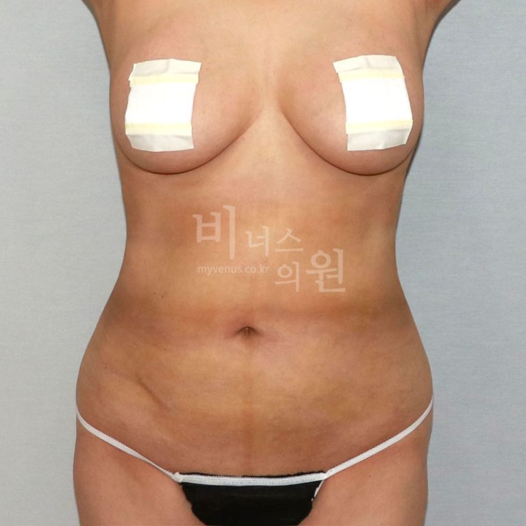 복부지방흡입 후 회복, 실제로 어떤가요? — 수술 당일부터 3개월 체감 변화