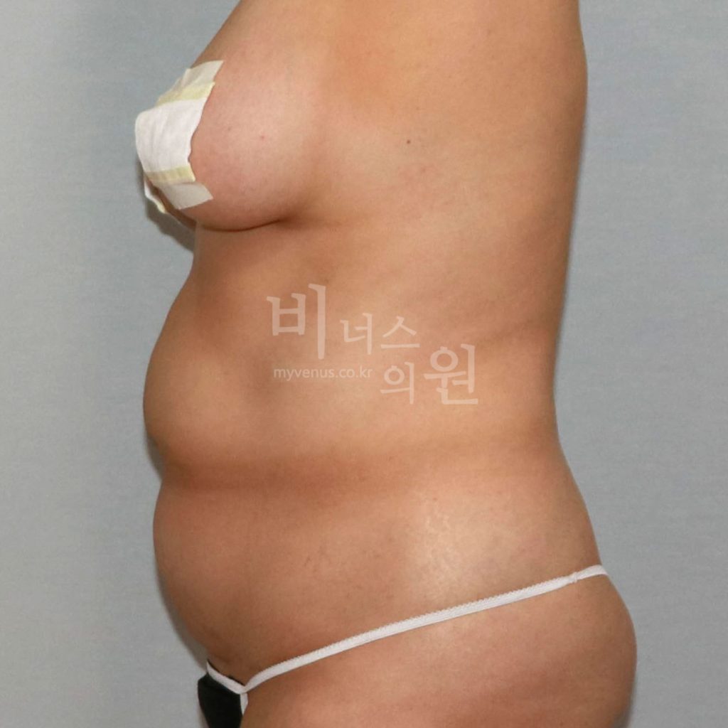 원통형 복부 지방흡입 수술 전 우측면