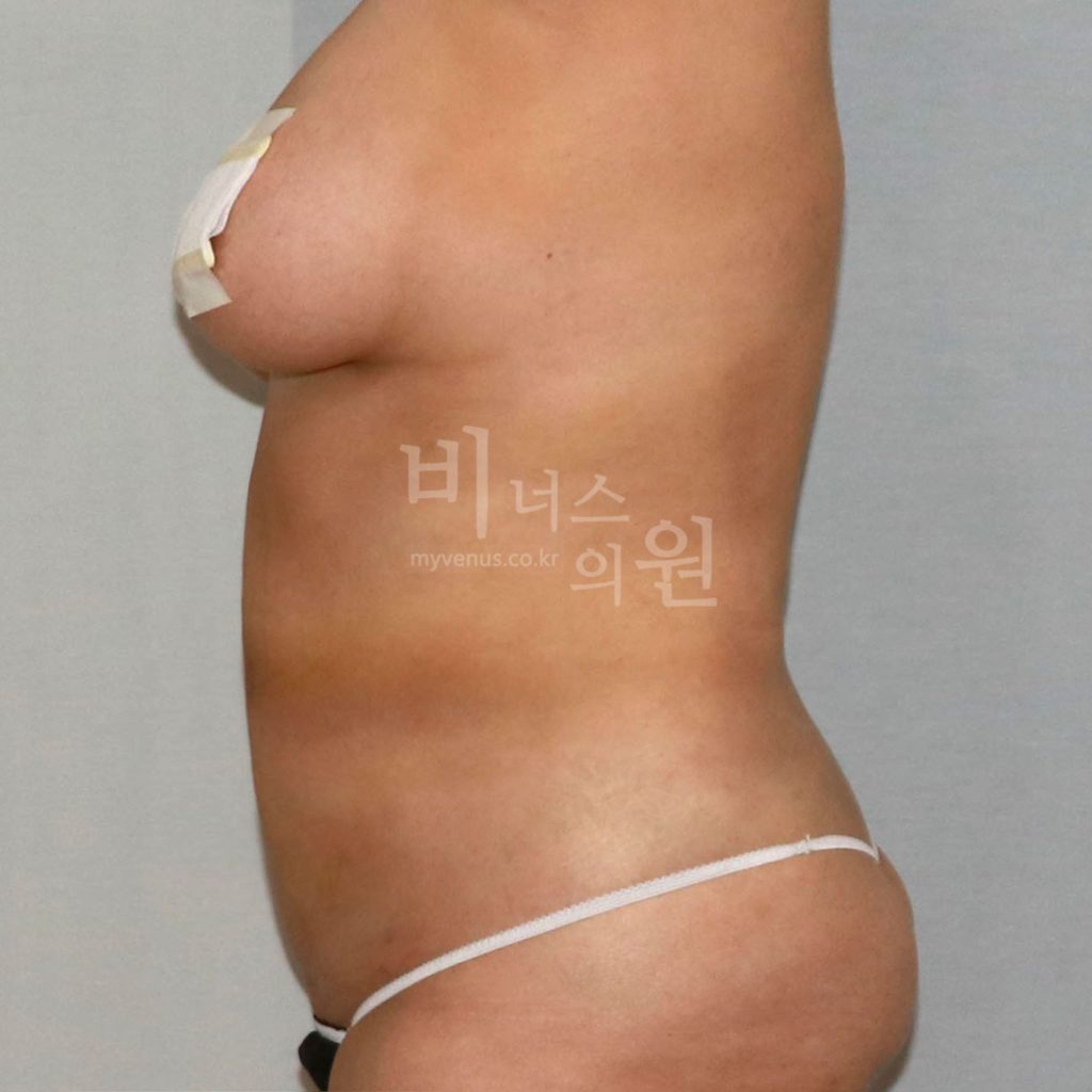 원통형 복부 지방흡입 수술 후 우측면