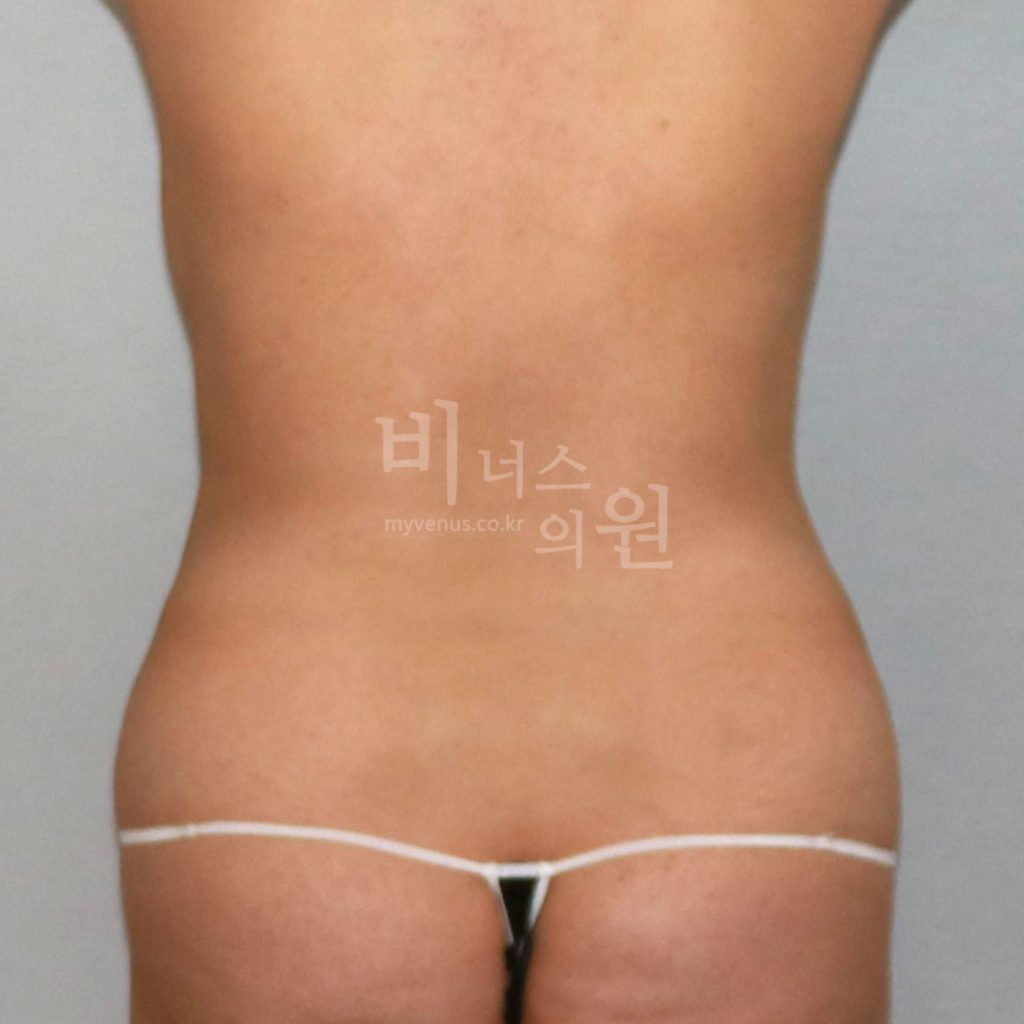 원통형 복부 지방흡입 수술 전 후면