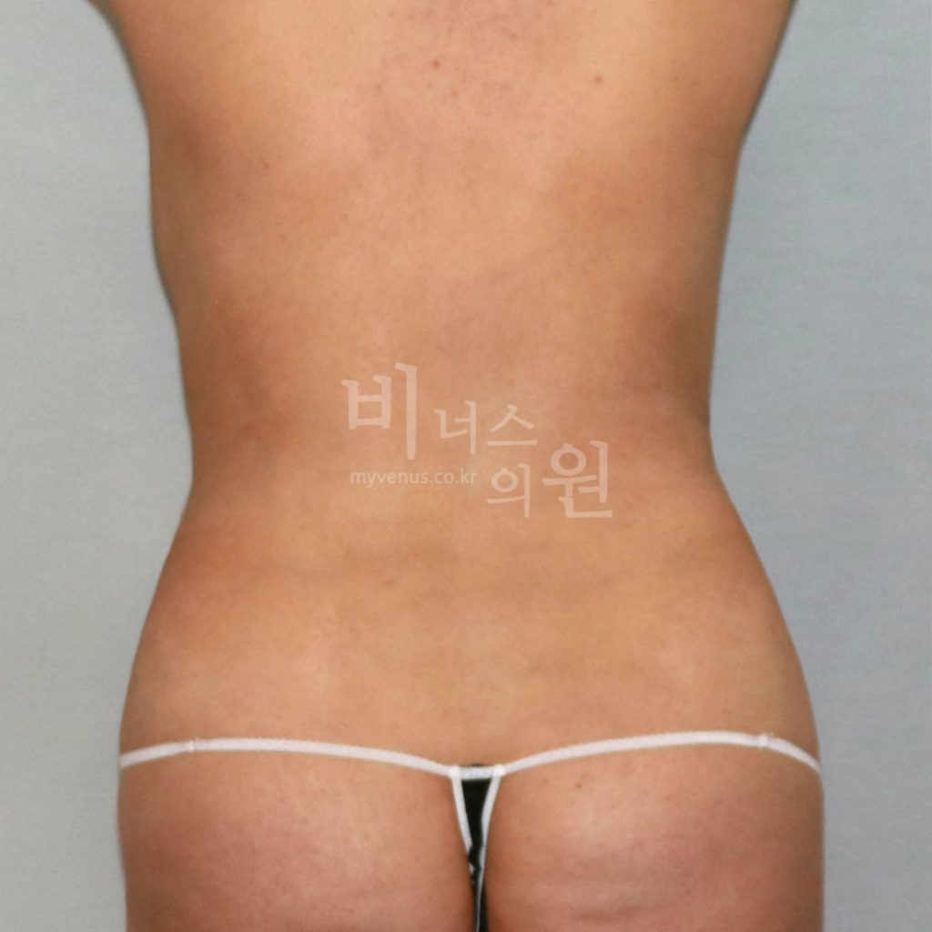 원통형 복부 지방흡입 수술 후 후면