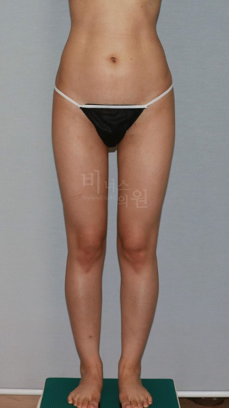 엉덩이 지방흡입 회복 일지 — 압박복부터 체형 변화 시점까지, 궁금한 것 모두